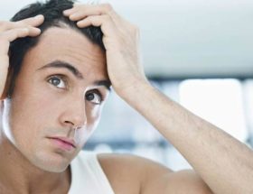 implants capillaires homme