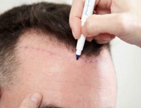 techniques de greffe de cheveux