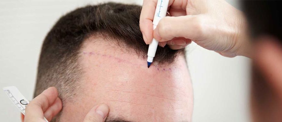 techniques de greffe de cheveux
