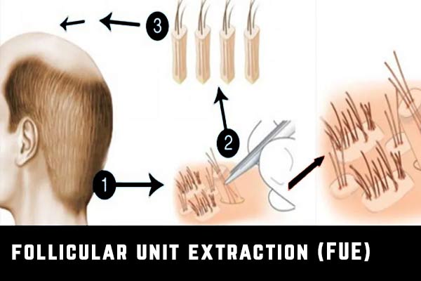 techniques greffe de cheveux fue
