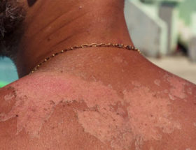 peau qui pèle homme arrêter de peler