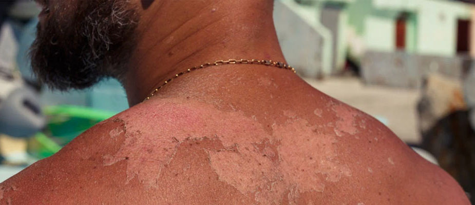 peau qui pèle homme arrêter de peler