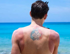 soulager un coup de soleil