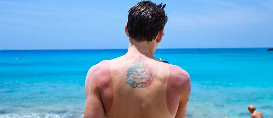 soulager un coup de soleil