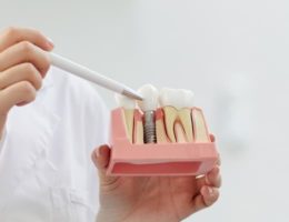 implants dentaires technologies