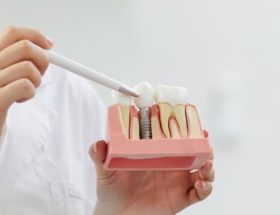 implants dentaires technologies