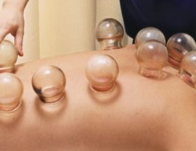 cupping therapy