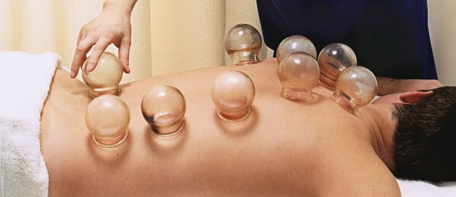 cupping therapy